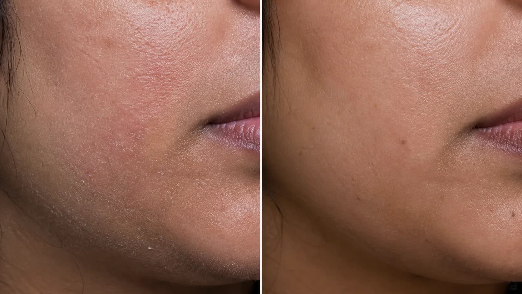 Barrier Protocol — before & after, 12 weeks