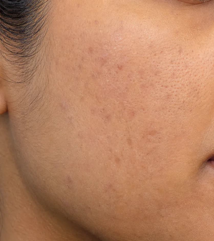 Clarté MD protocol — after, week 12