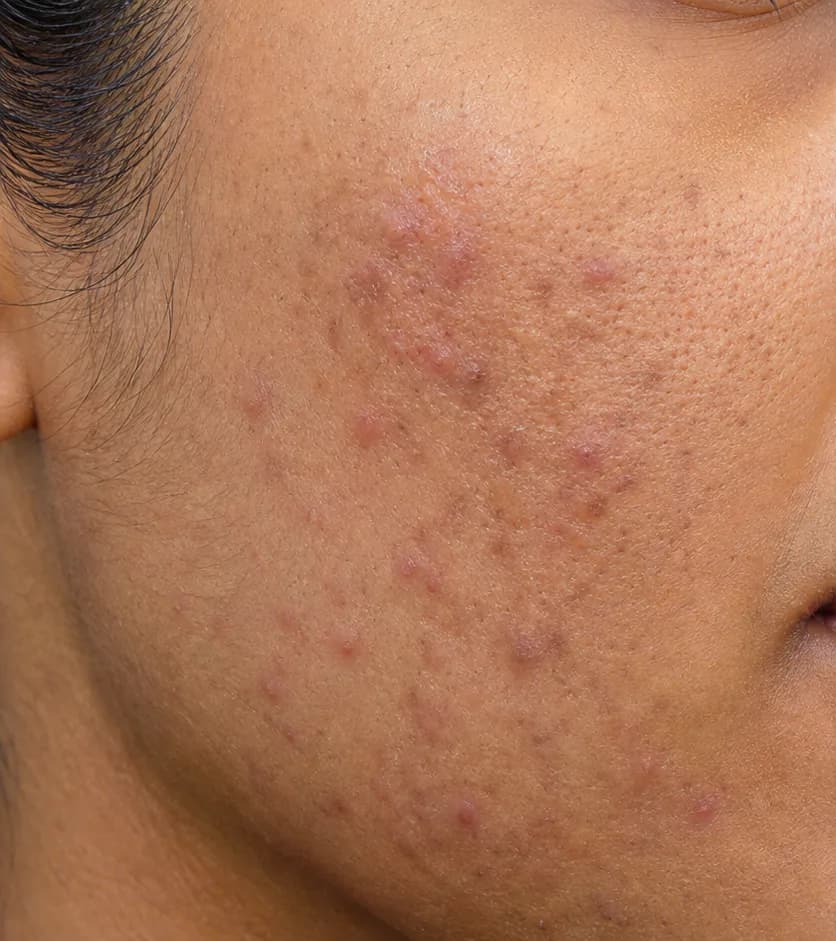 Clarté MD protocol — before, week 12