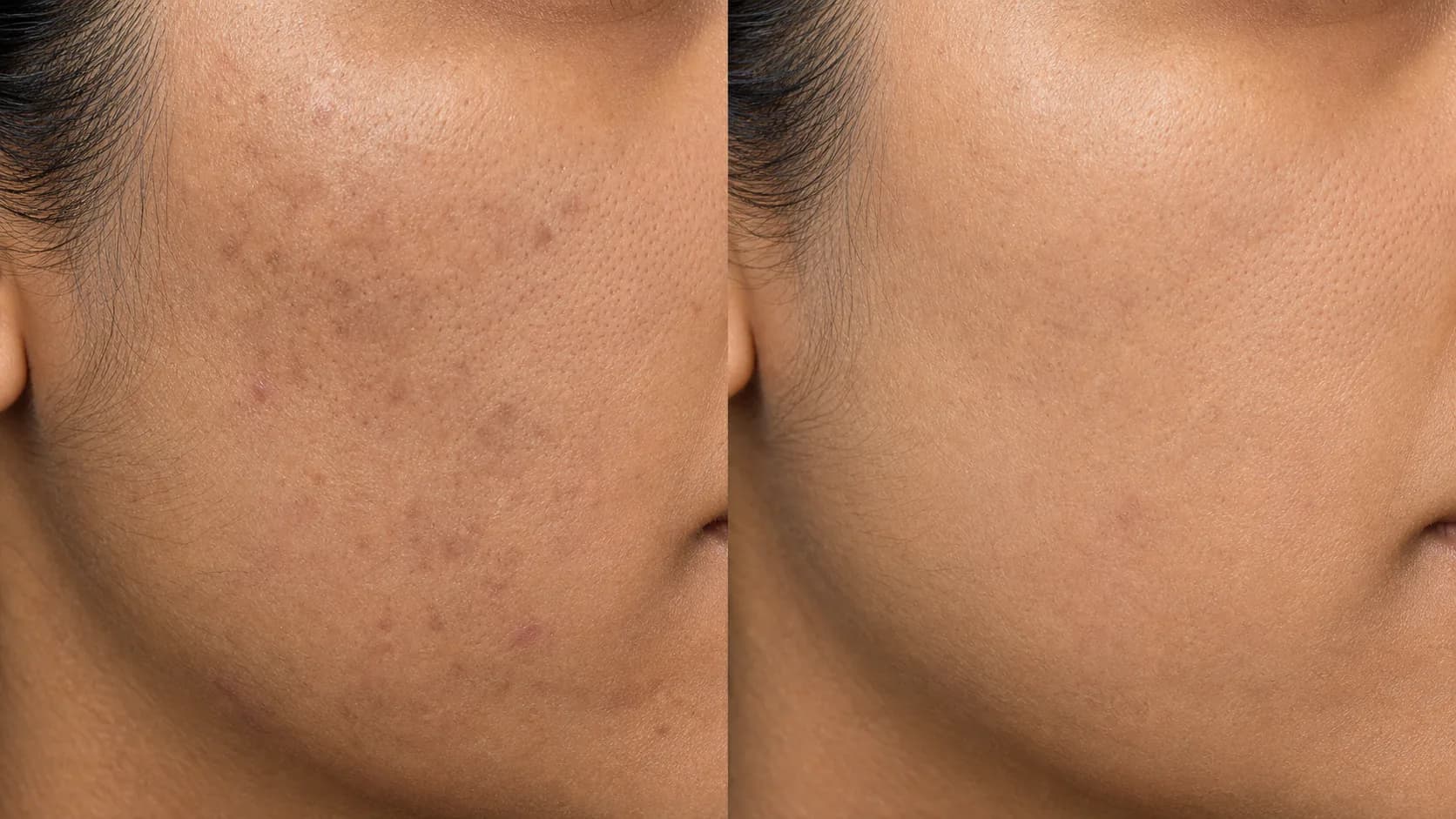 Clear-Skin Protocol — before & after, 8 weeks