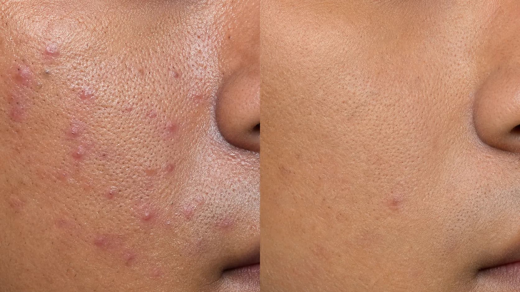 Clear-Skin Protocol — before & after, 12 weeks