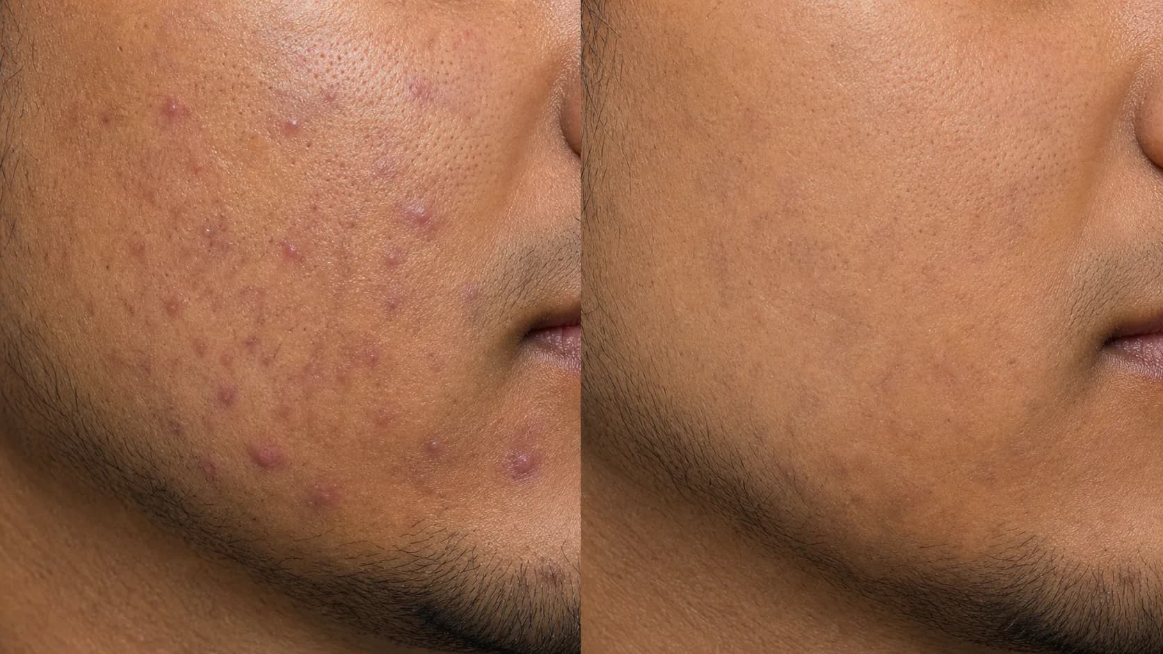 Clear-Skin Protocol — before & after, 12 weeks
