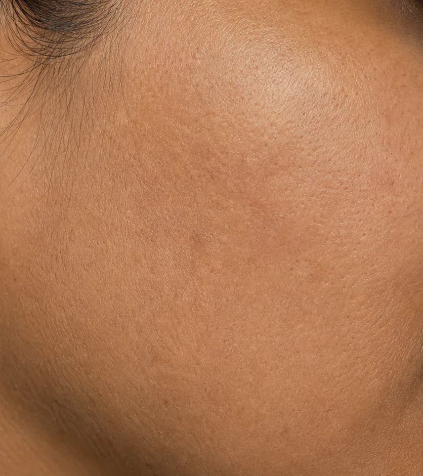 Clarté MD protocol — after, week 12