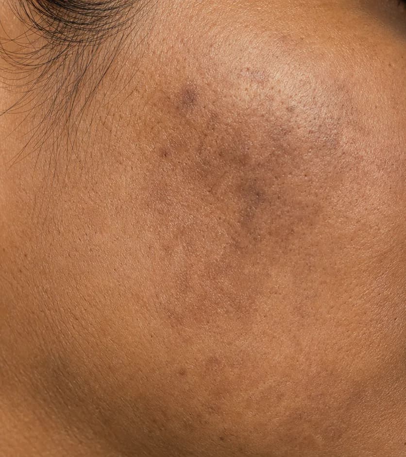 Clarté MD protocol — before, week 12