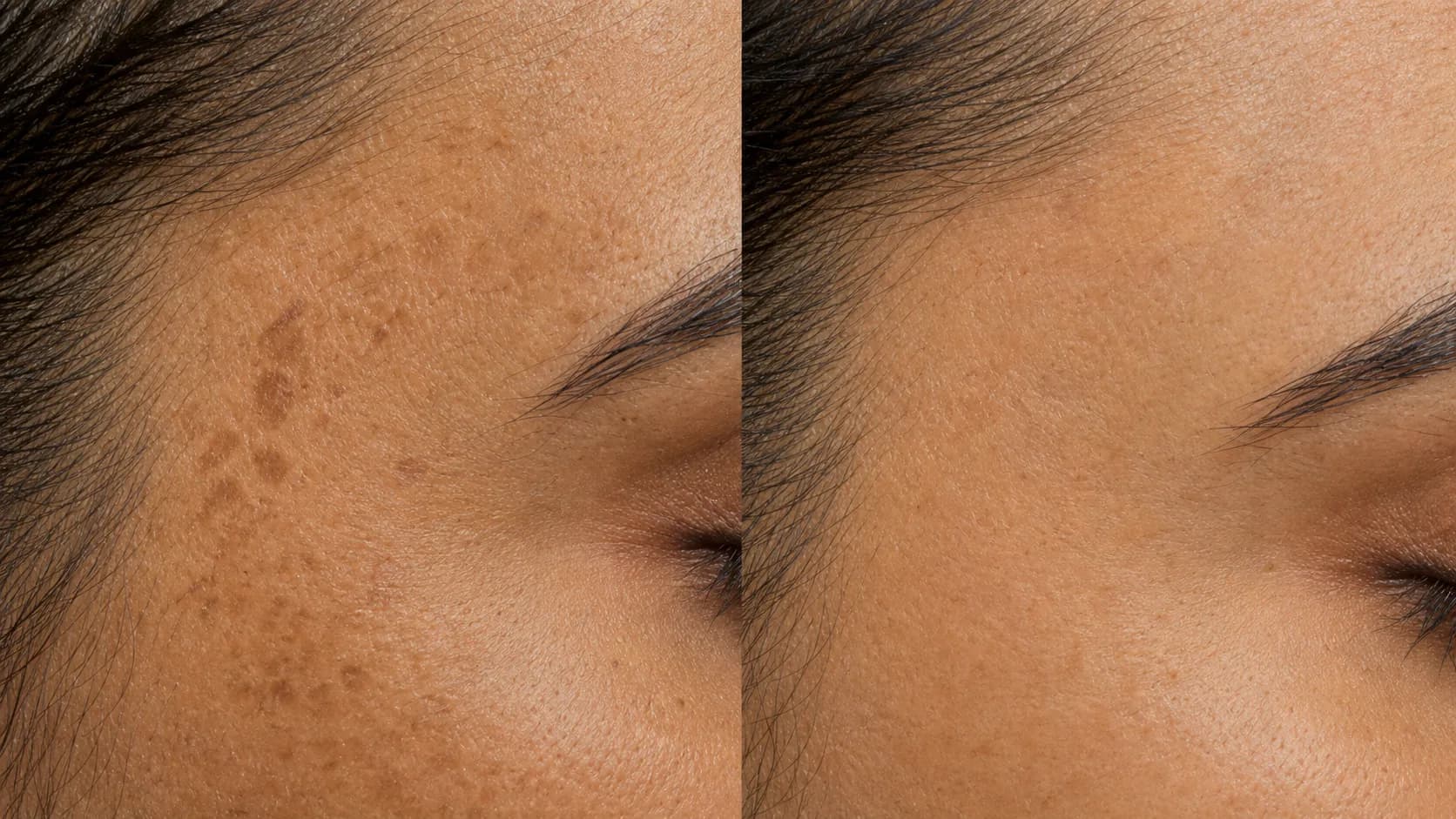 Even-Tone Protocol — before & after, 12 weeks