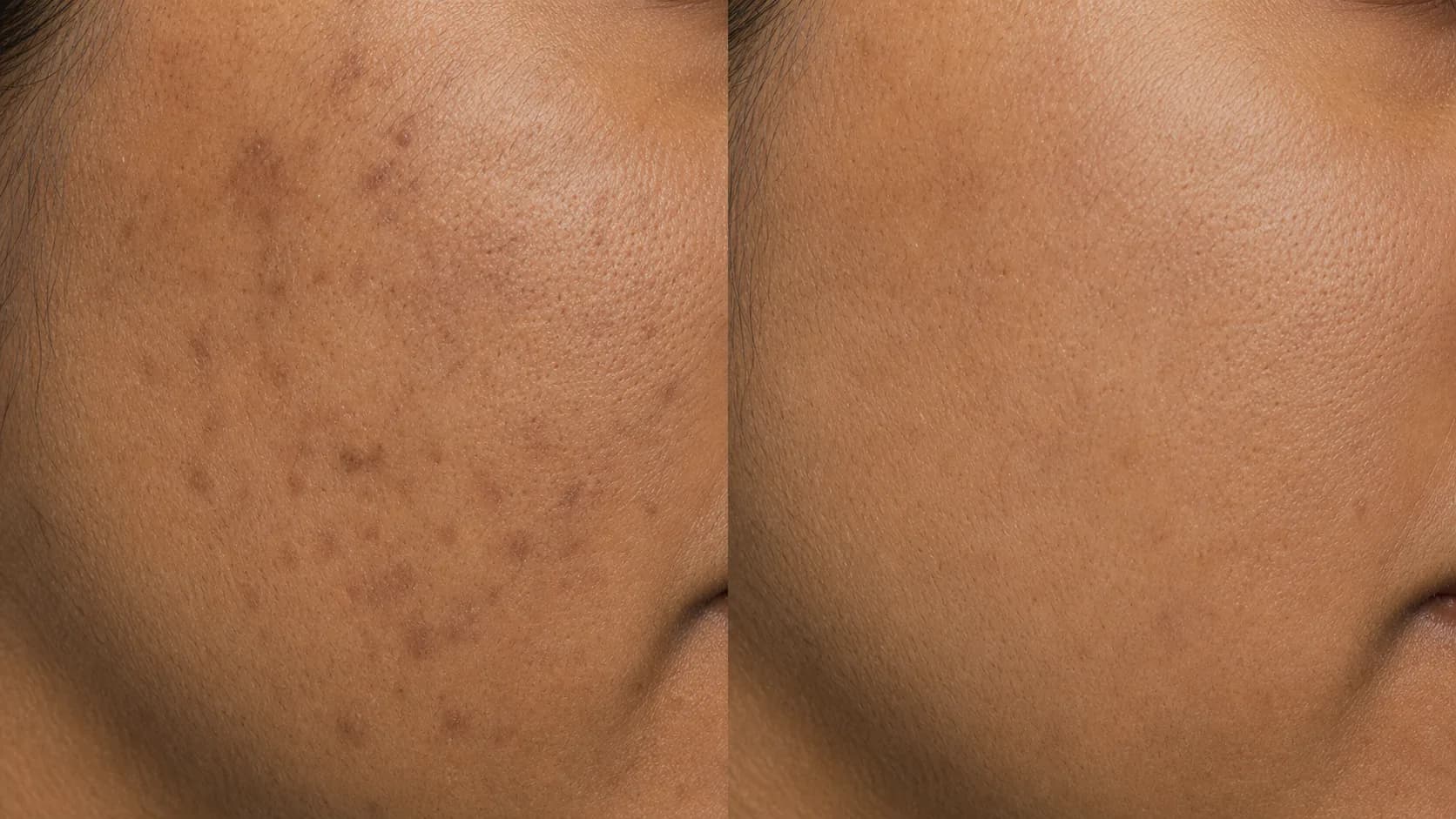 Even-Tone Protocol — before & after, 12 weeks