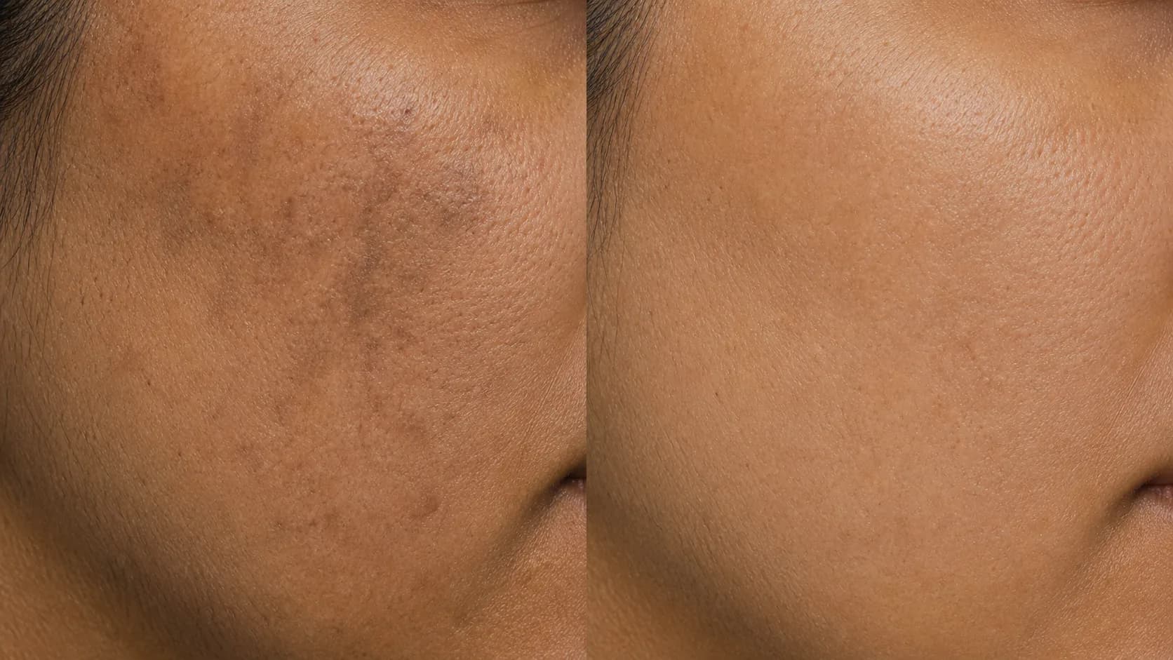 Even-Tone Protocol — before & after, 8 weeks