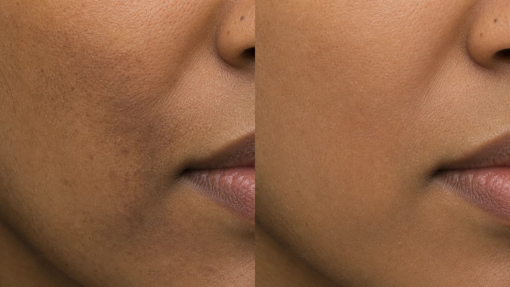 Even-Tone Protocol — before & after, 12 weeks