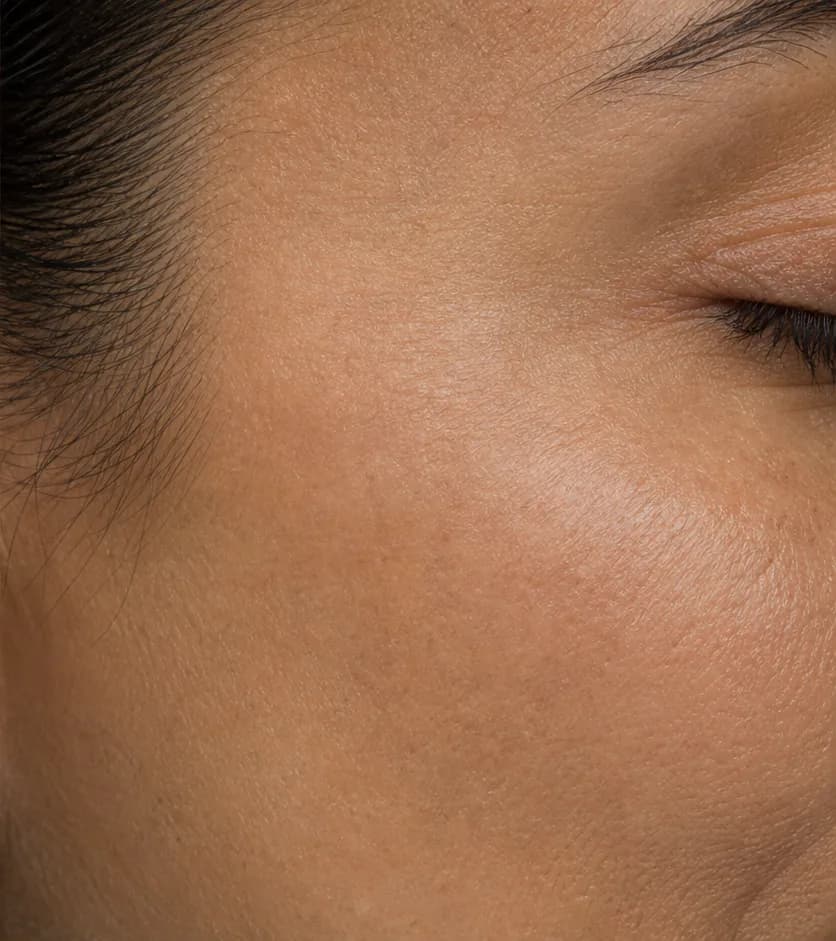Clarté MD protocol — after, week 12