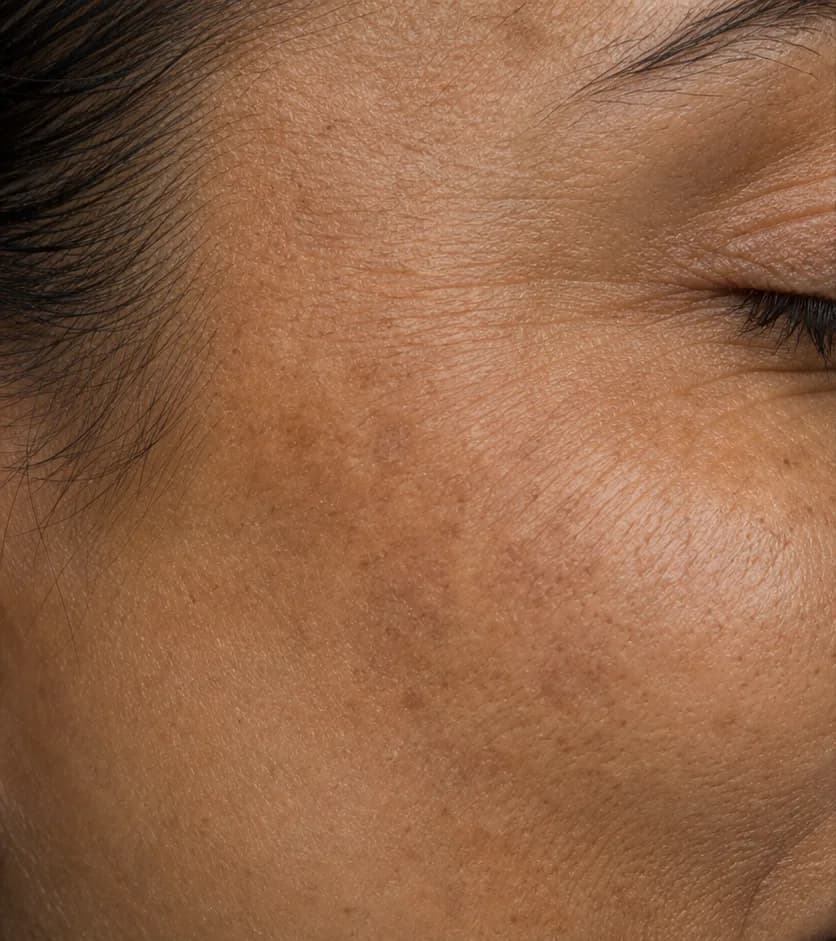 Clarté MD protocol — before, week 12