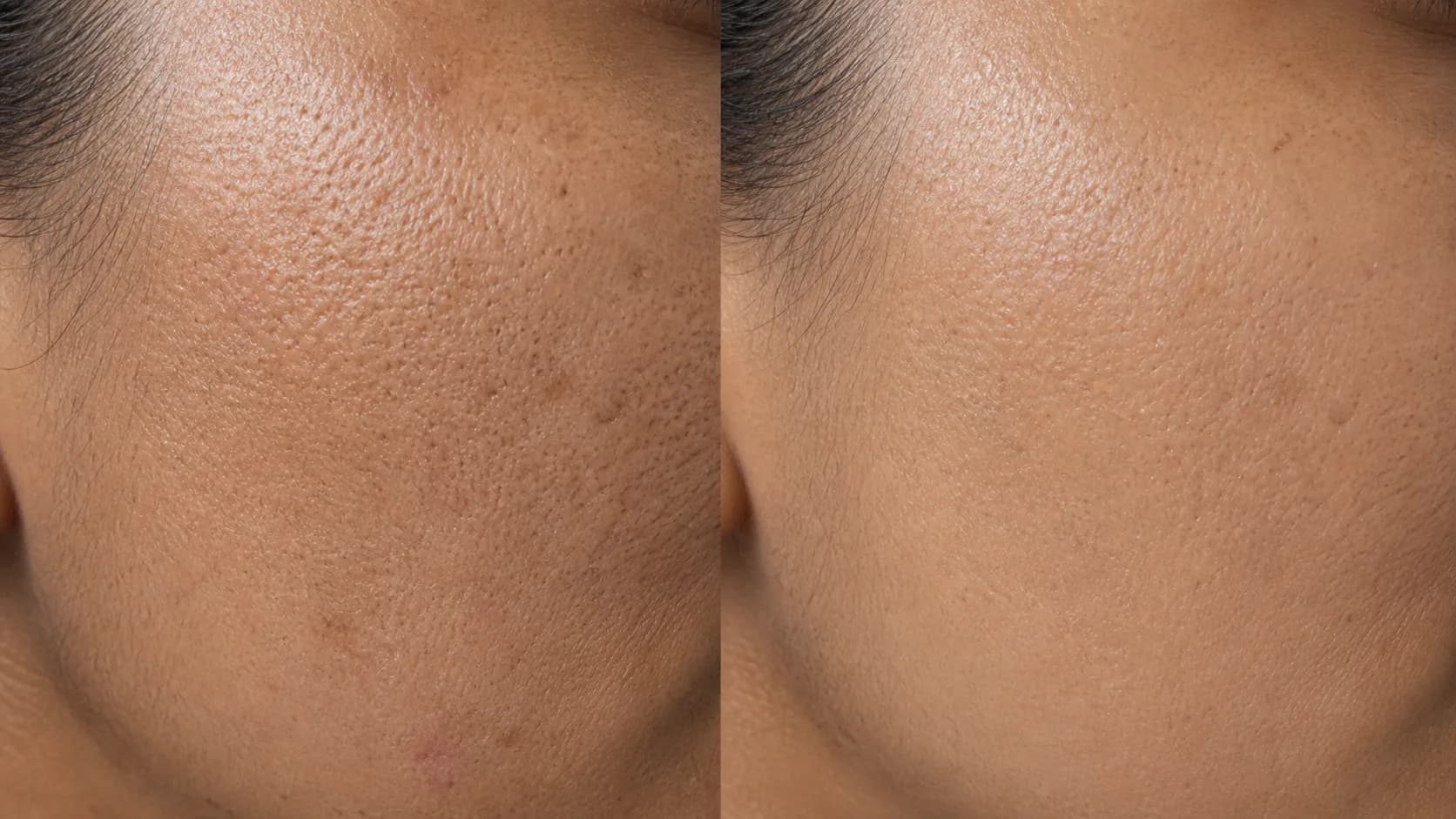 Renewal Protocol — before & after, 12 weeks