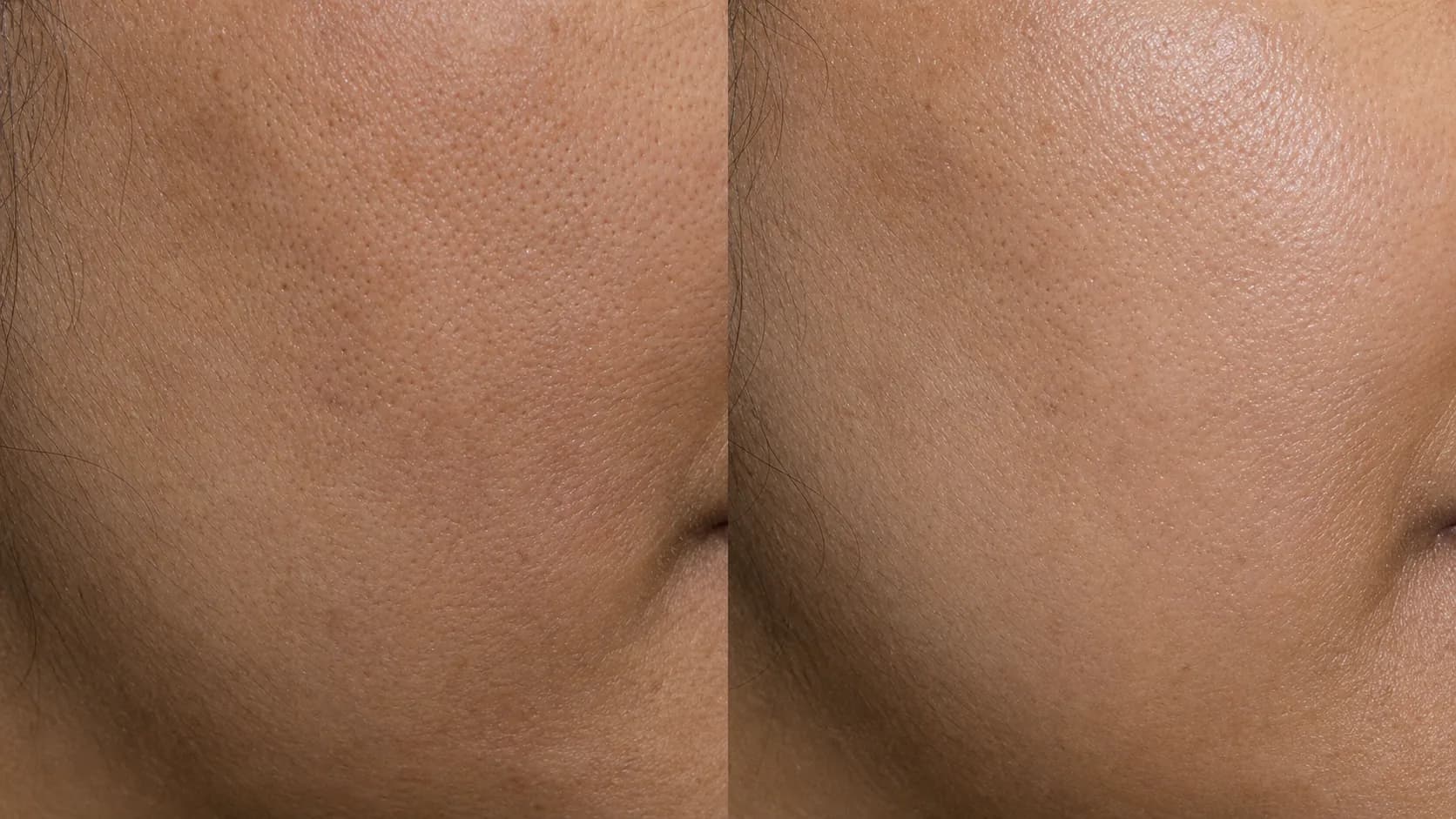 Renewal Protocol — before & after, 12 weeks